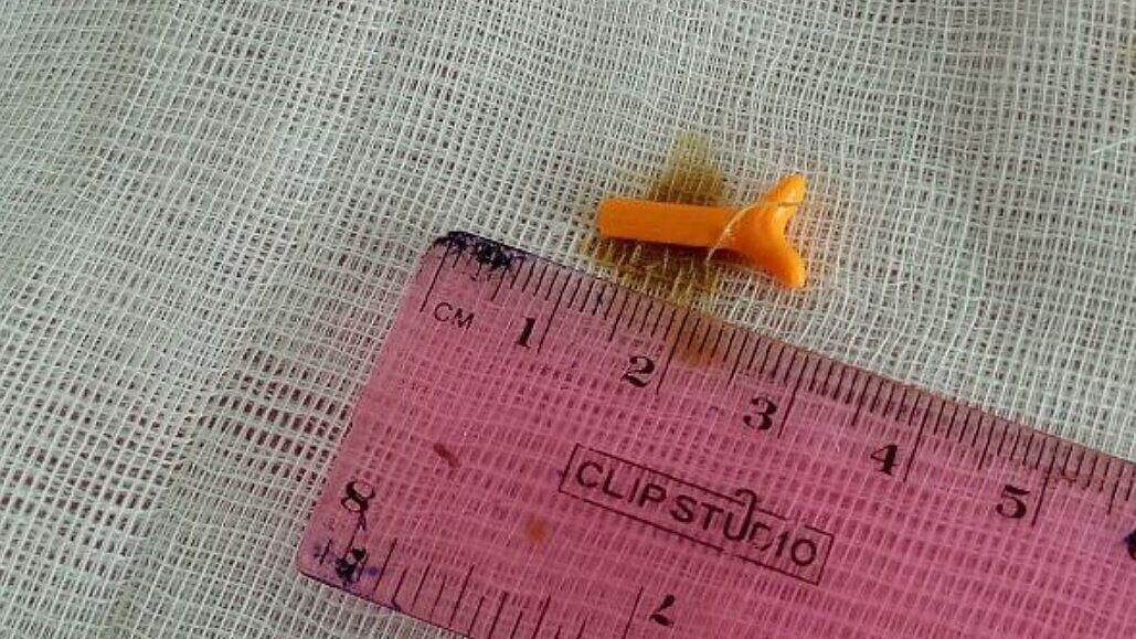 В Кузбассе из уха пациентки извлекли деталь конструктора спустя 20 лет