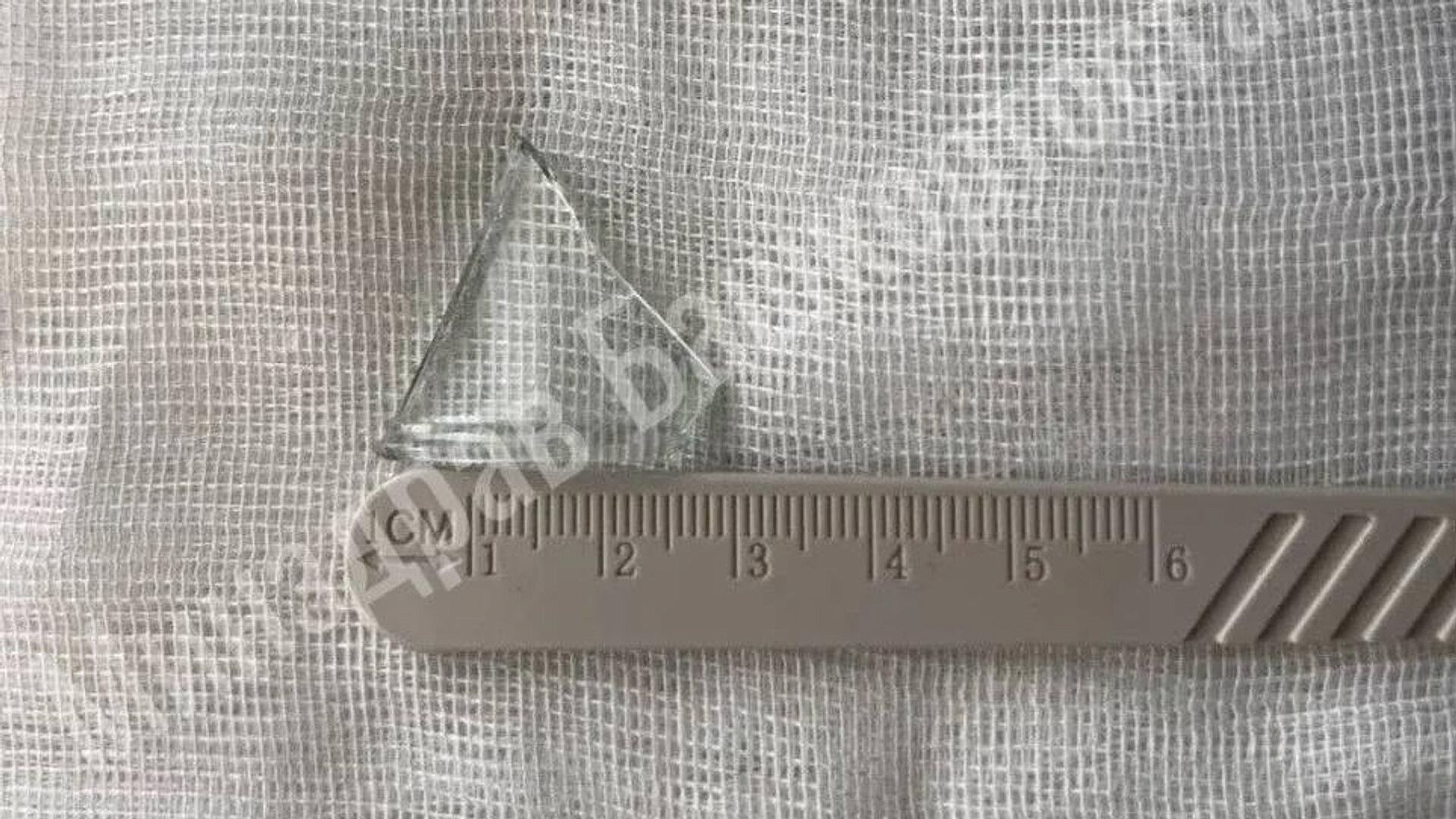 В Уфе врачи спасли мужчину, проглотившего крупный осколок стекла