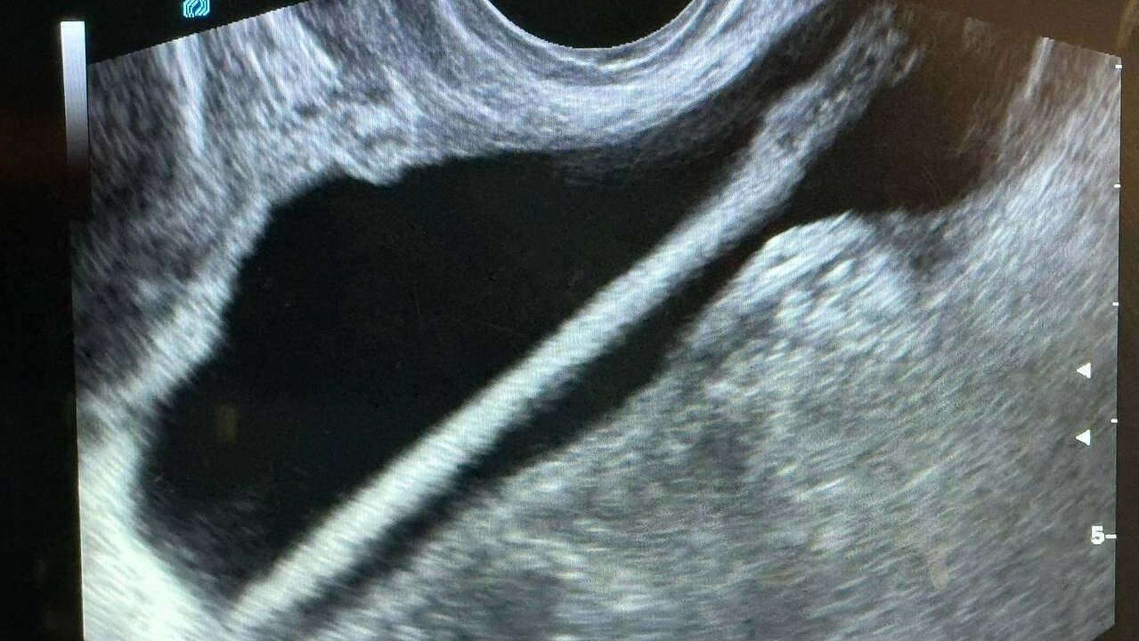 В Подмосковье врачи достали из мочевого пузыря женщины карандаш