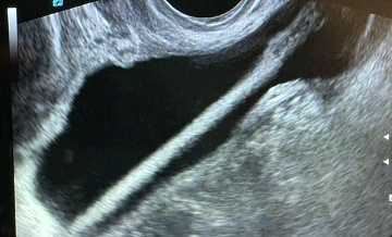 В Подмосковье врачи достали из мочевого пузыря женщины карандаш