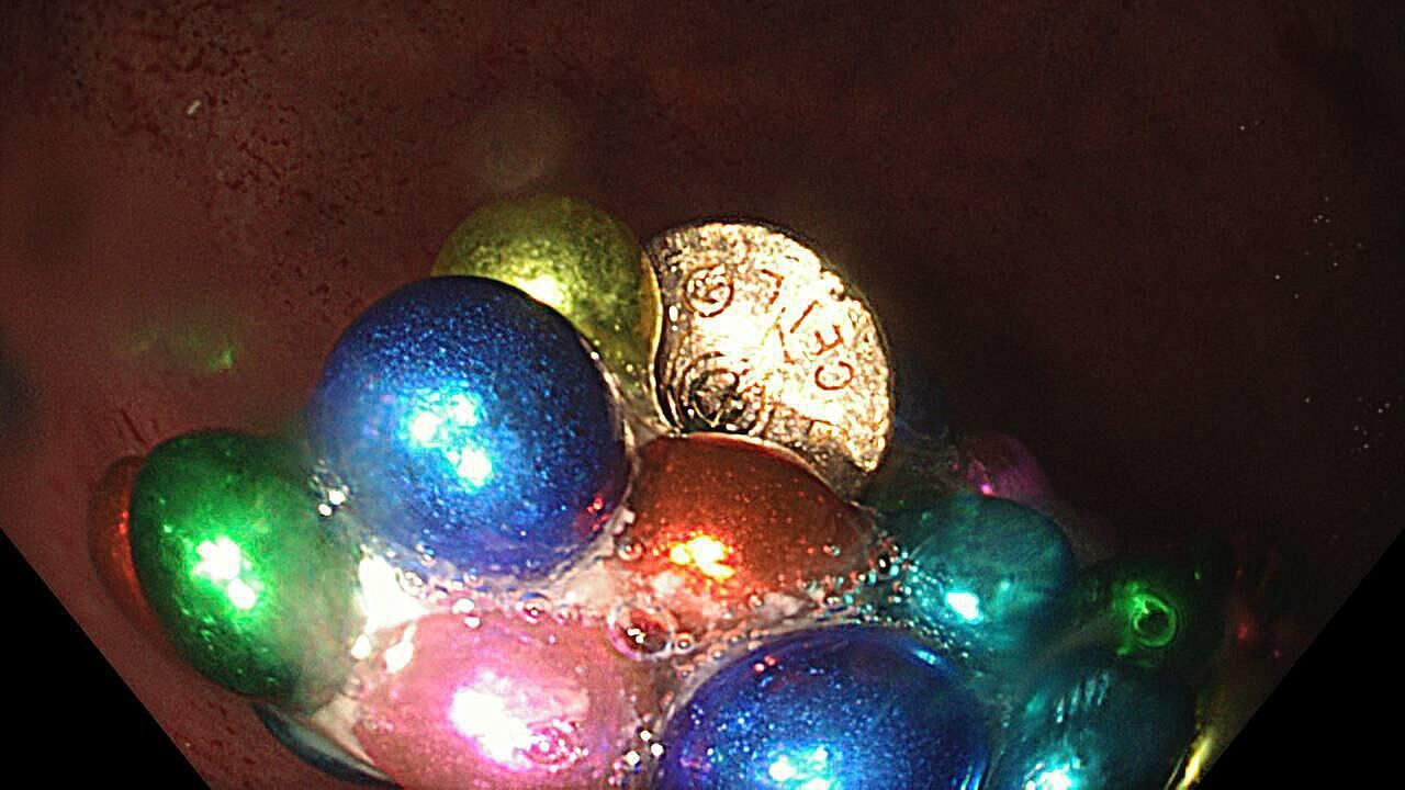 В Подмосковье спасли полуторагодовалого ребенка, проглотившего 130 магнитов