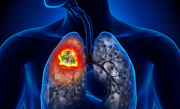 СМИ рассказали о неочевидных симптомах смертельного заболевания