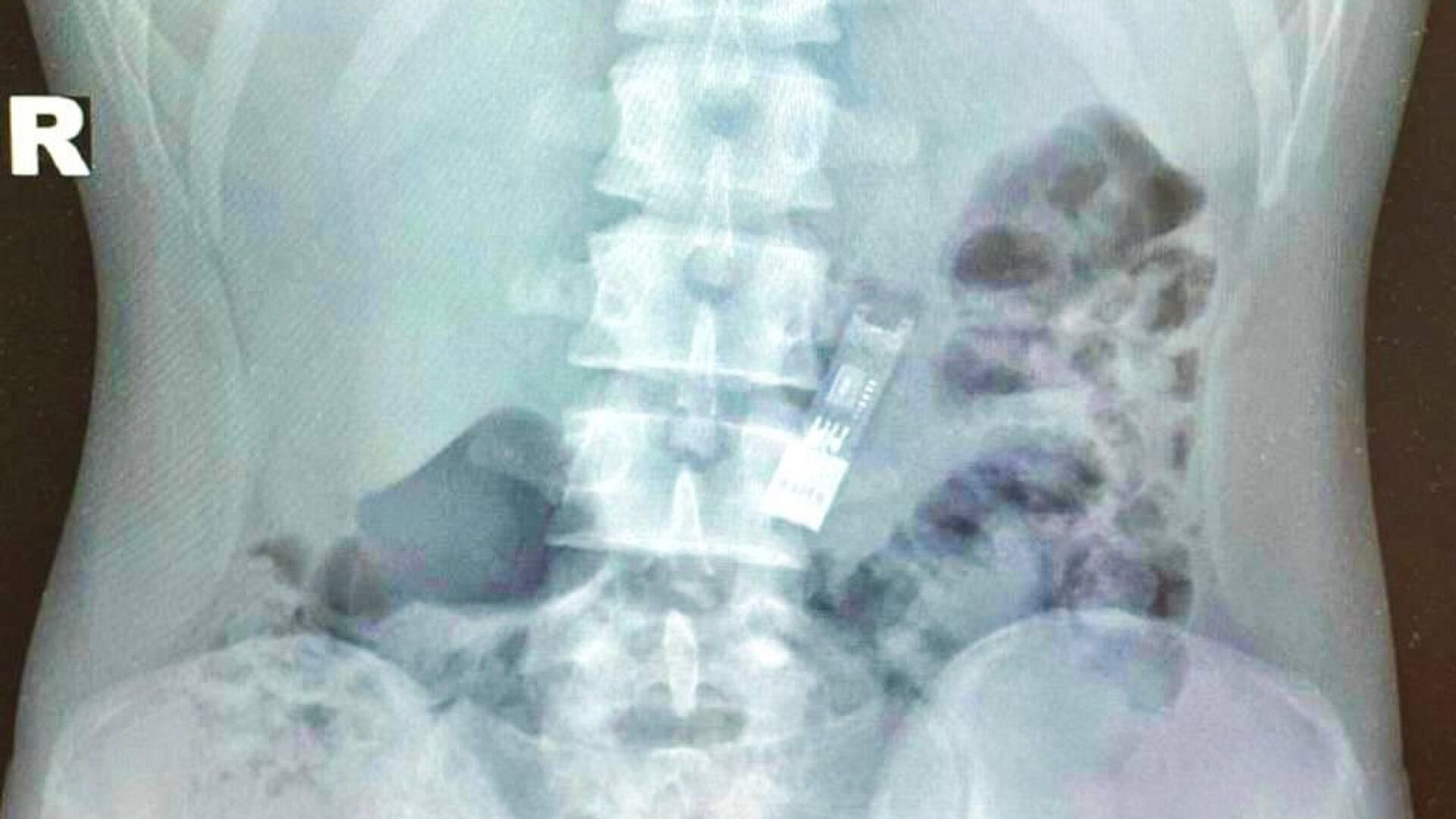 Врачи извлекли флешку из желудка школьника